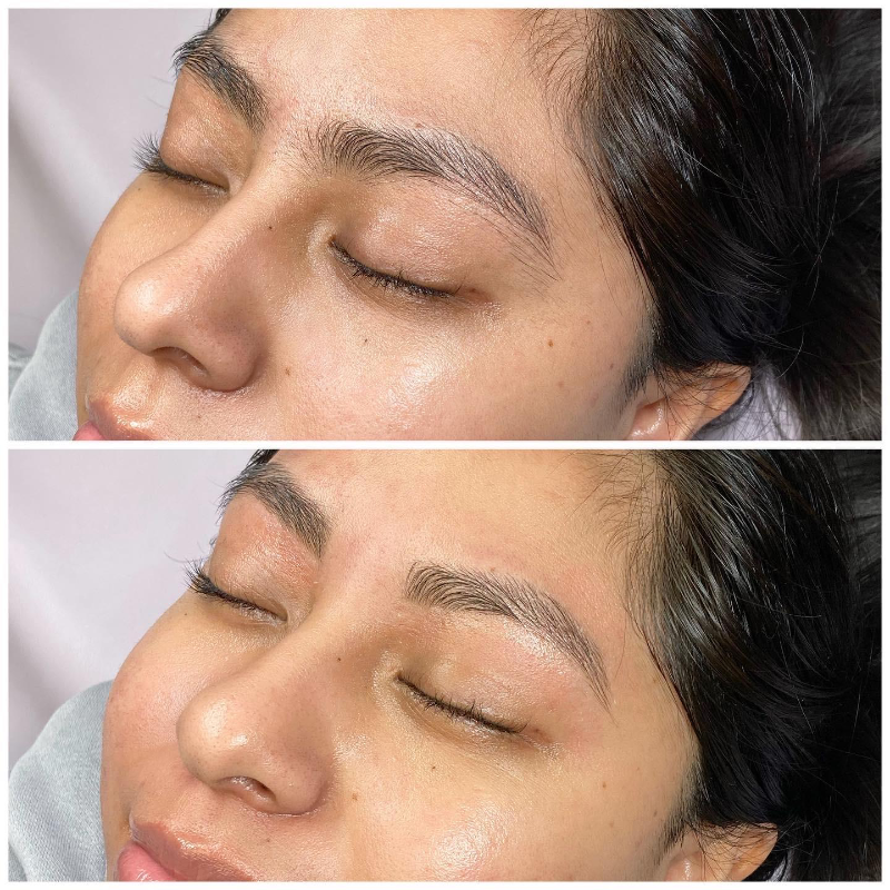 What to Expect After a Thread Brow Lift? - Yastrid Medical Aesthetic  Supplier